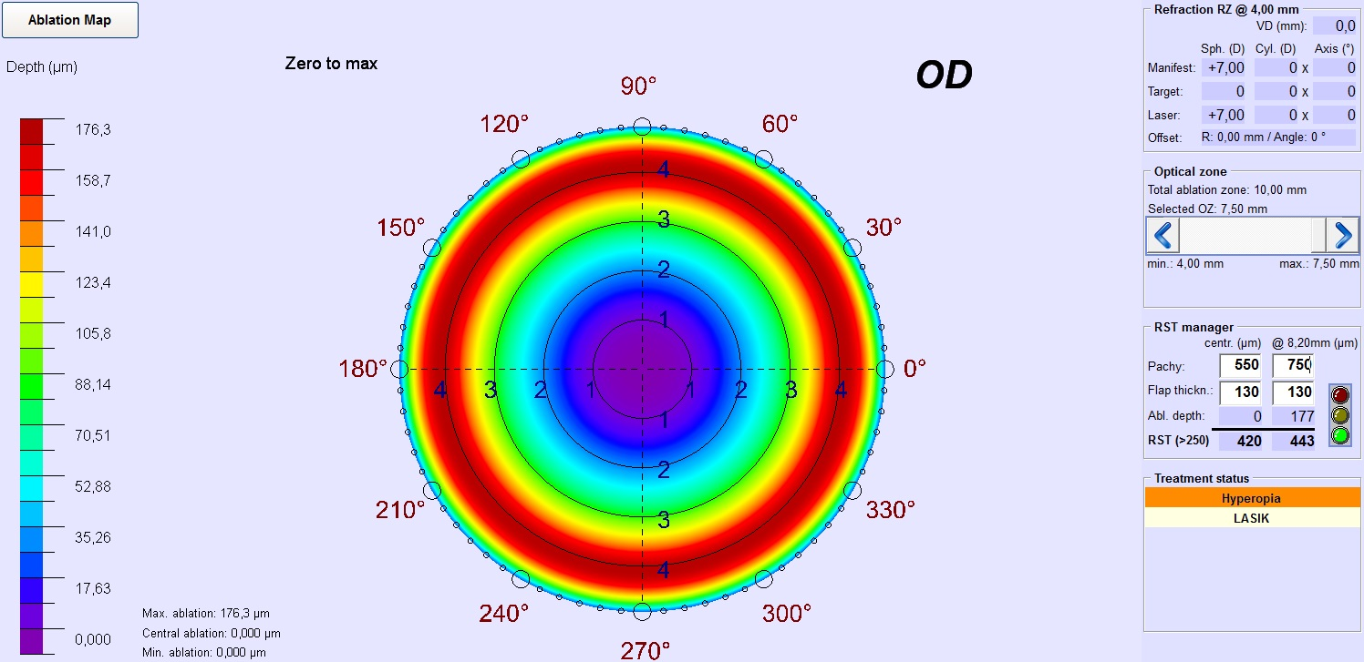 Example for the correction of +7D (corneal plane) with 7.5 mm optical zone