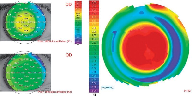 Wide homogenious optical zone before (#2) and after (#1) +6.00 D hyperopic correction