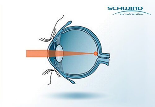 Light refraction in the eye with presbyopia