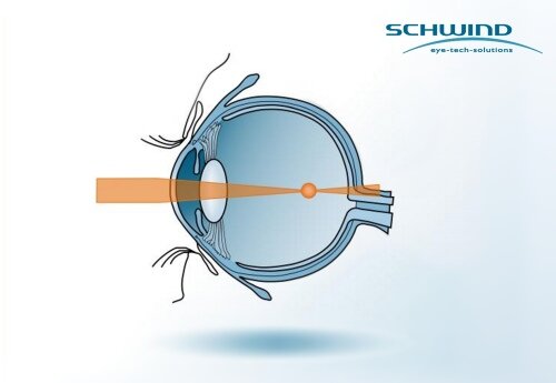 Lichtbrechung im Auge bei Kurzsichtigkeit