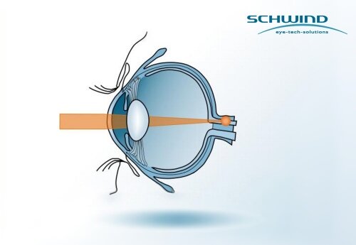 Light refraction in the eye with longsightedness