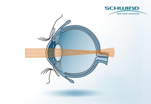 Light refraction in the eye with aberrations