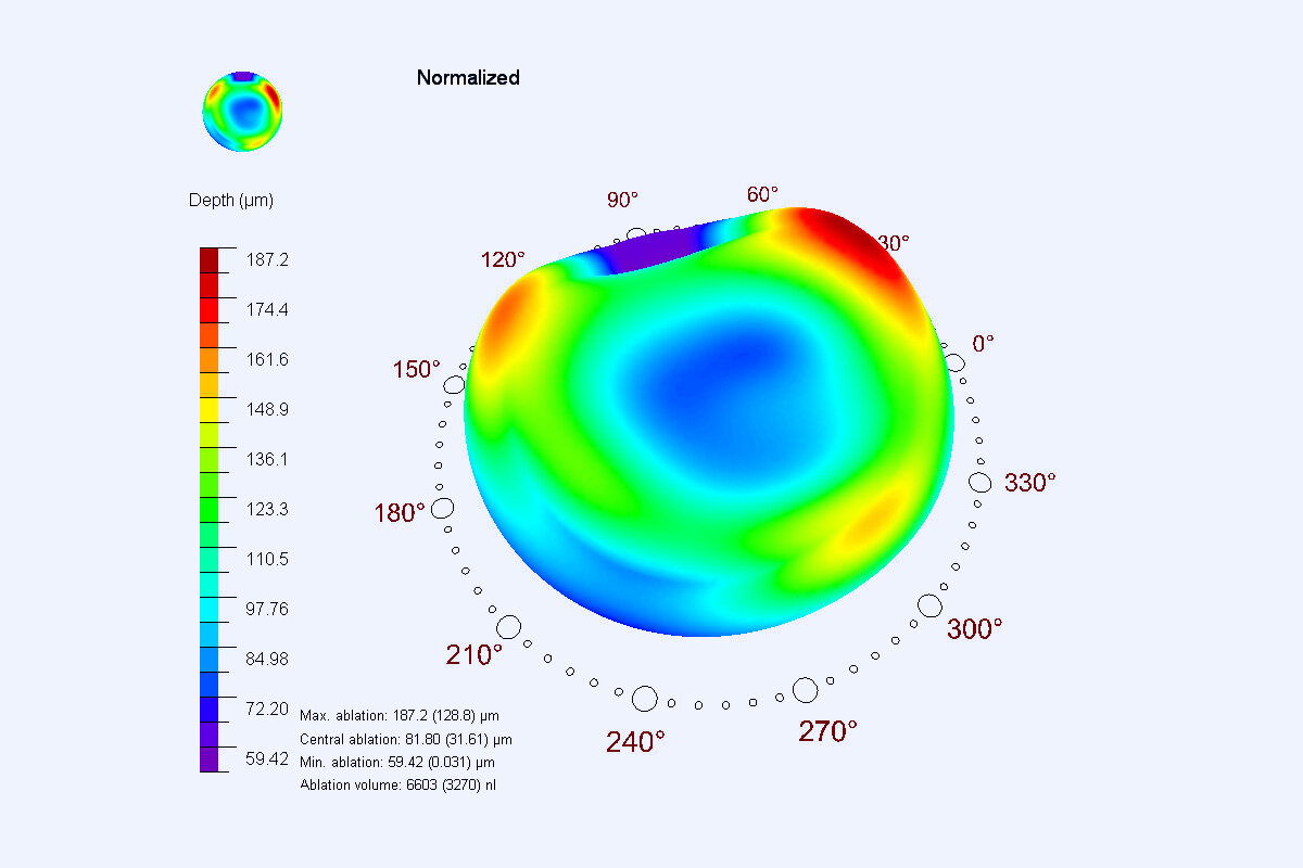 ablation profile during follow-up treatment