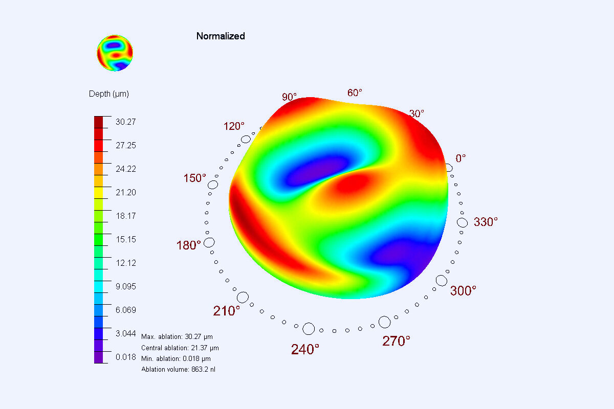 Height scale of an eye during treatment with ORK CAM