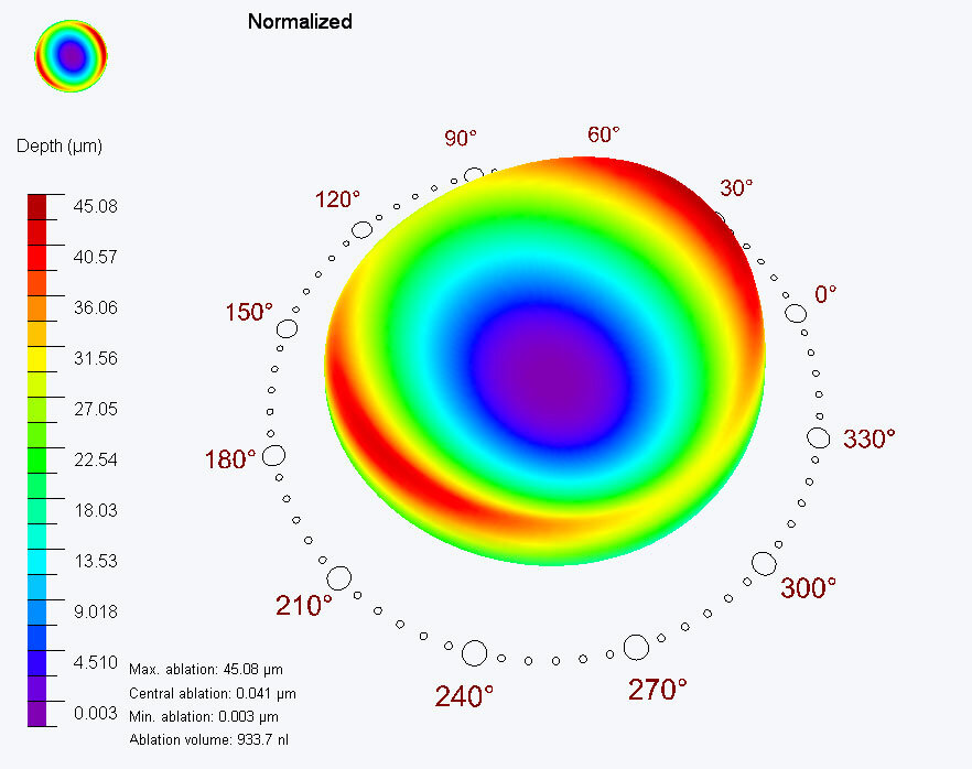 High scala of the dominant eye during treatment