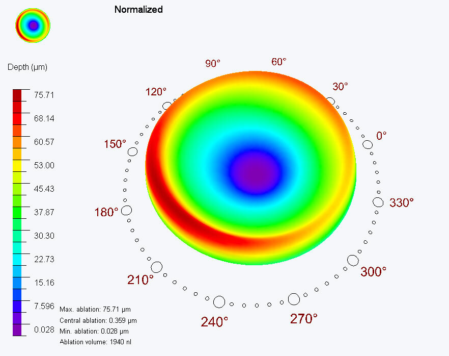 High scala of the non-dominant eye during treatment