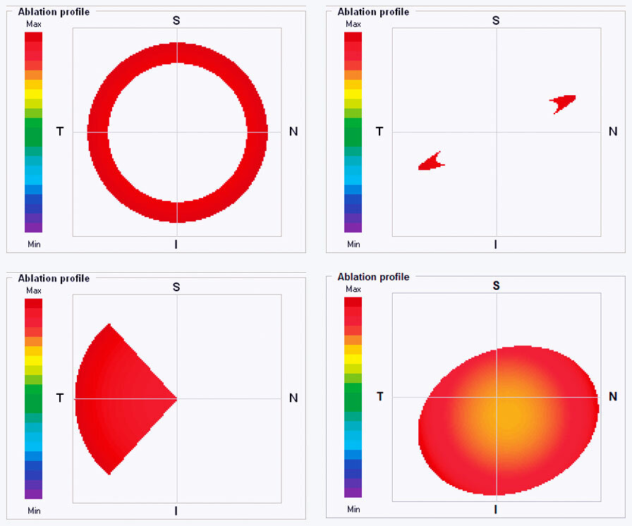 Overview of height scales of an eye during treatment with PTK Cam