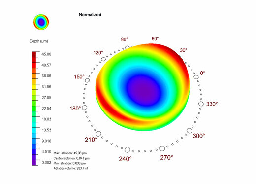 Ablation profile CAM with PresbyMAX