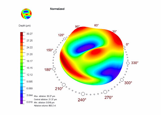 Ablation profile CAM with ORK