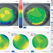 Ablation profile with wavefront