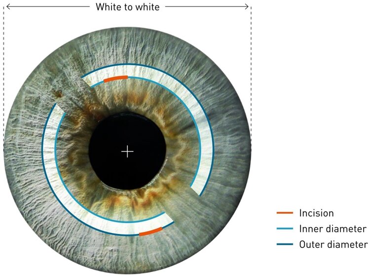 Creating a corneal tunnel for ring segment implantation (ICRS)