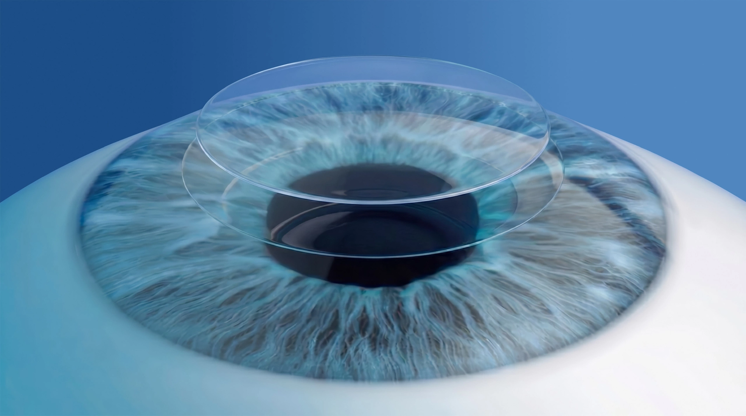 3D graphic demonstrating refractive EASE treatment on eye (Epithelial All-femtosecond Surface Excision) 