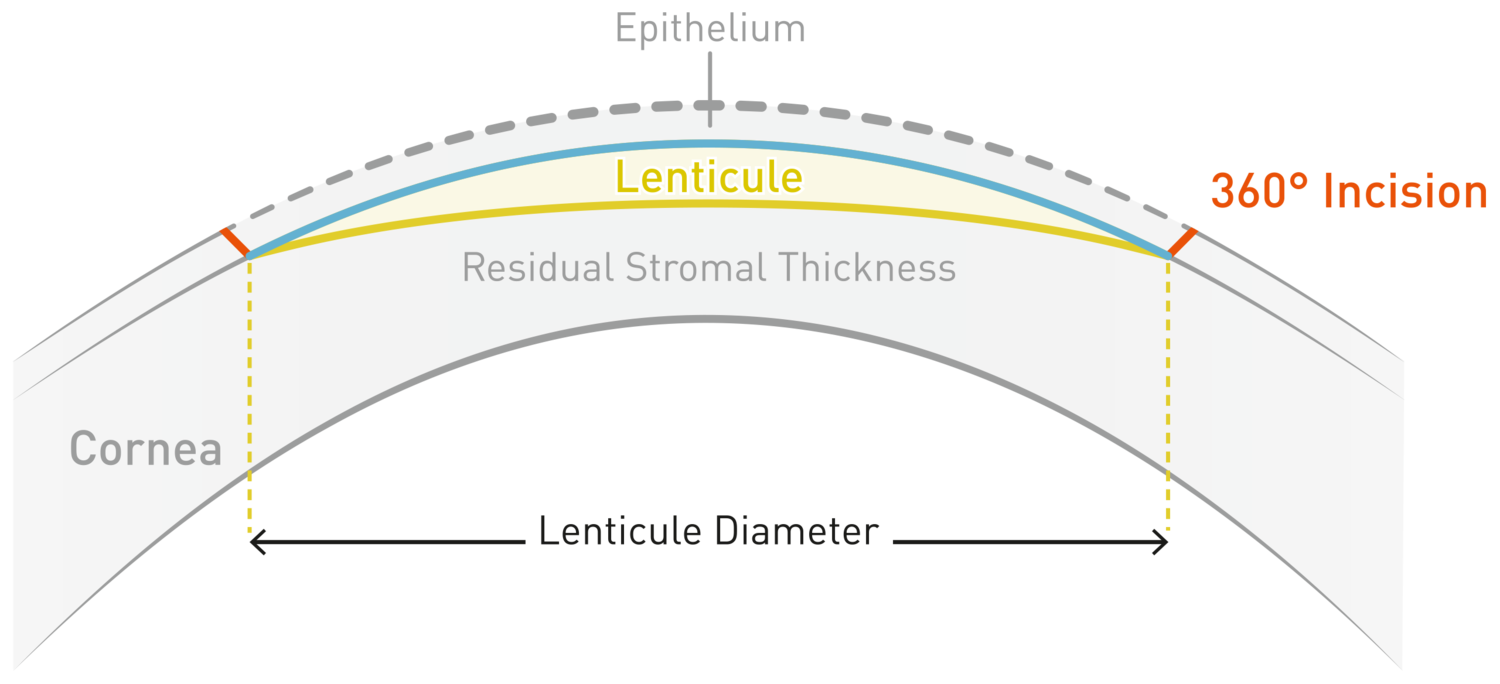 infographic on the cap-free lentoid approach