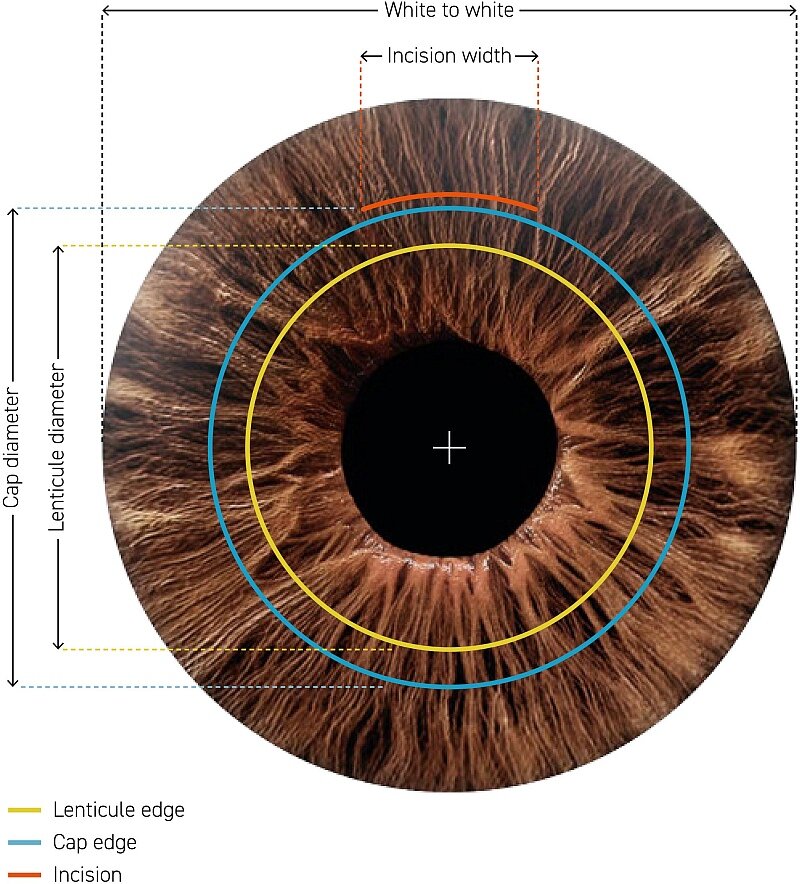 SCHWIND SmartSight Lenticule Eye