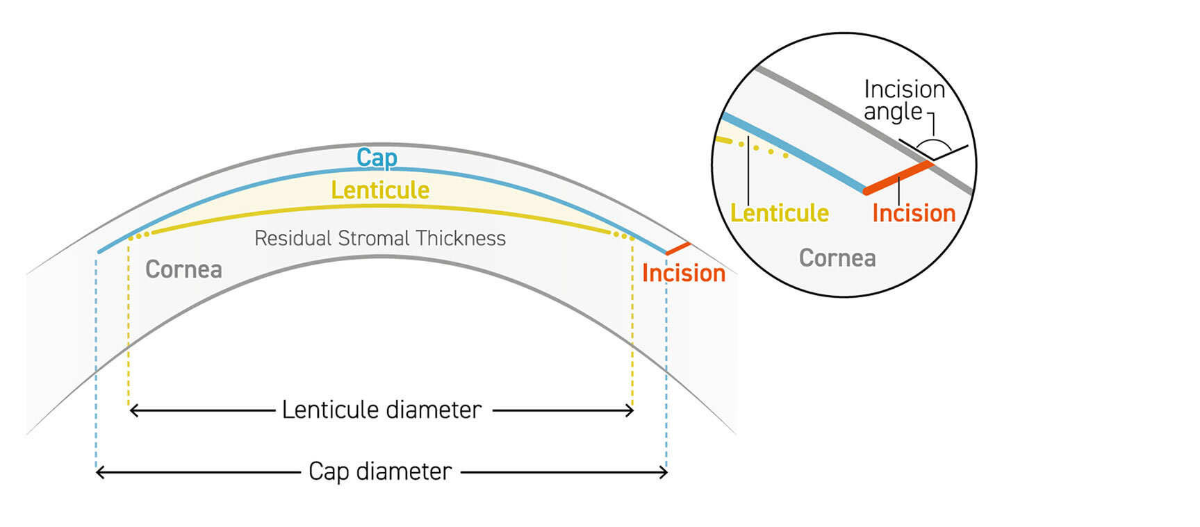 SCHWIND SmartSight Lenticule Graphic