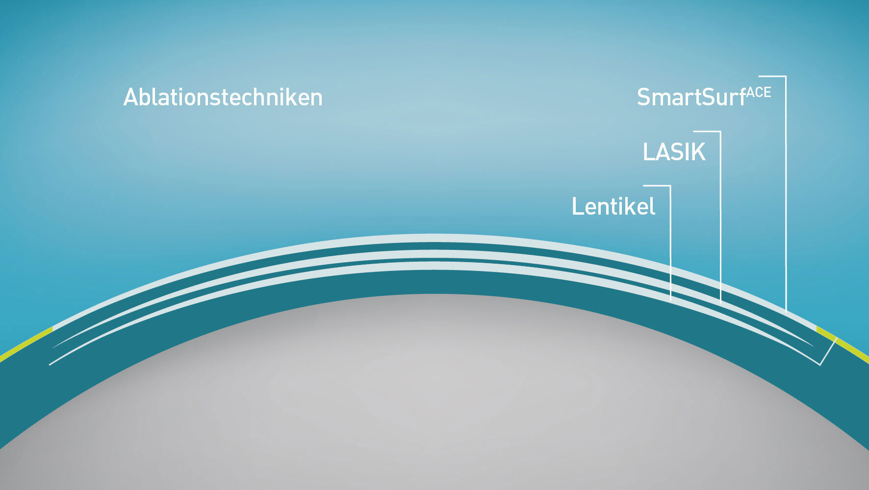 Grafische Darstellung eines Auges mit den Anwendungstiefen verschiedener Behandlungstechniken.