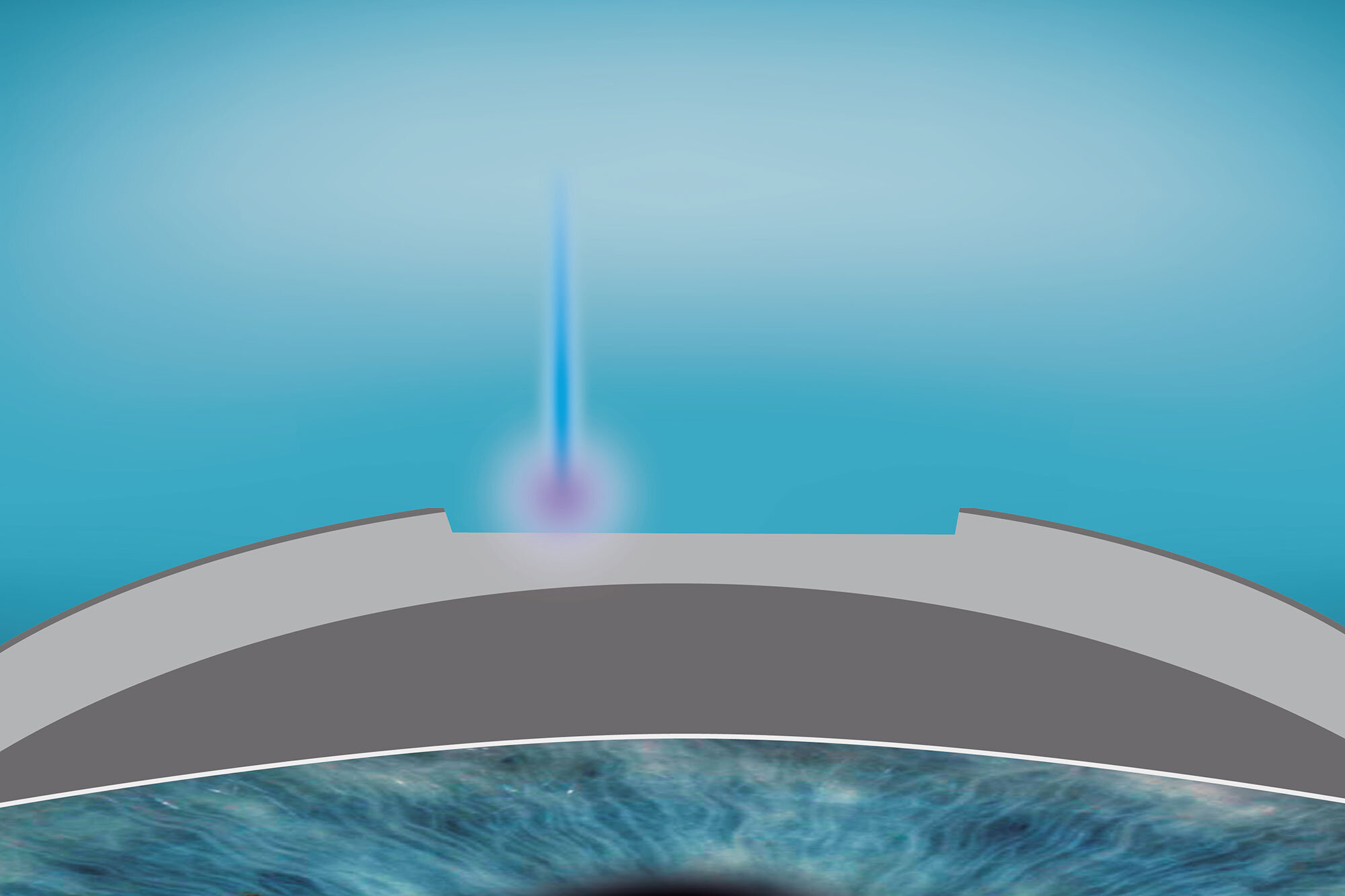 Illustration of regular cornea 3